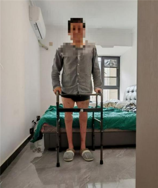 我国完成世界首例双大腿被绞断再植手术:男子20个月后恢复行走!